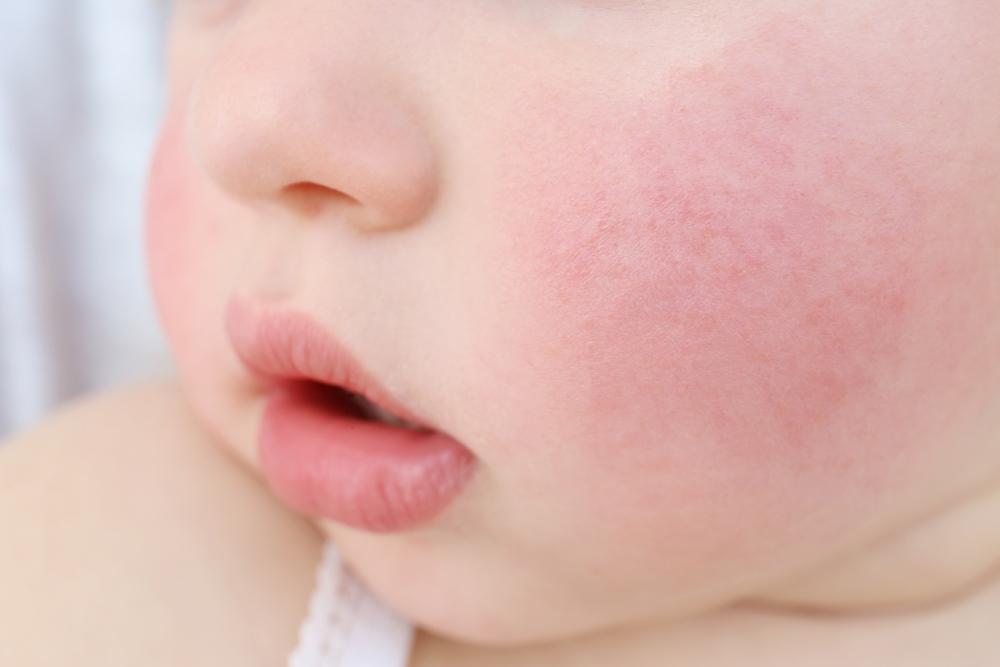 аллергия у детей что делать