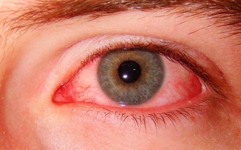 аллергия на глазах симптомы