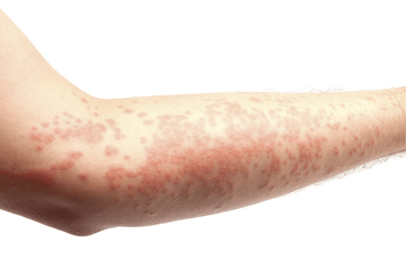 аллергия на фруктозу симптомы