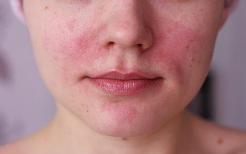 Аллергия на вишню