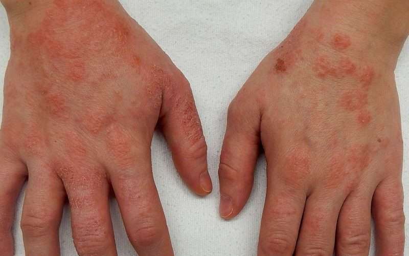 аллергия на руках симптомы