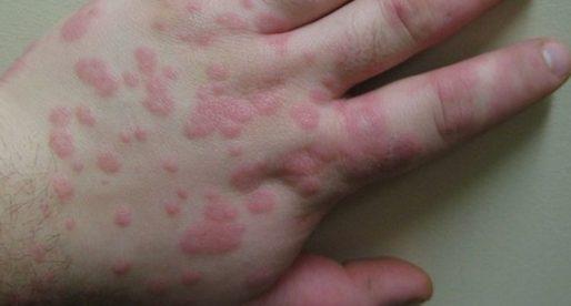 Аллергия в виде красных пятен