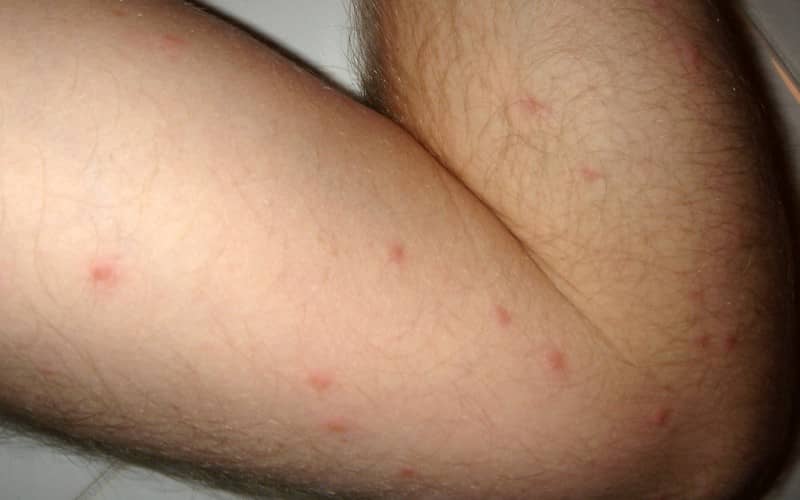признаки аллергический дерматит