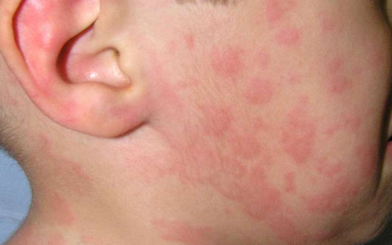 аллергия на солнечный свет симптомы