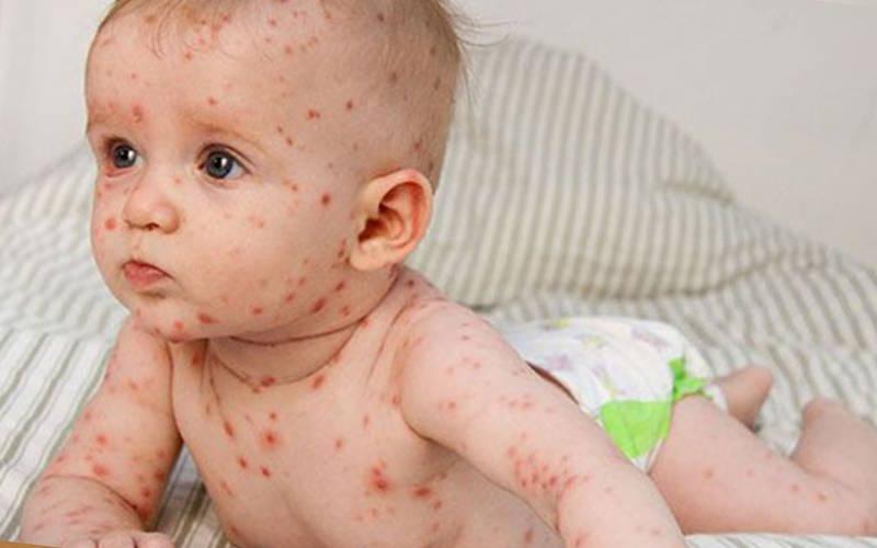 детская аллергия симптомы