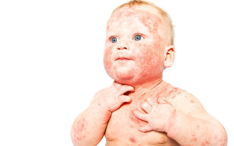 детская аллергия