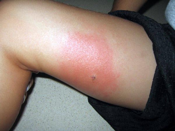 аллергия на укусы насекомых симптомы