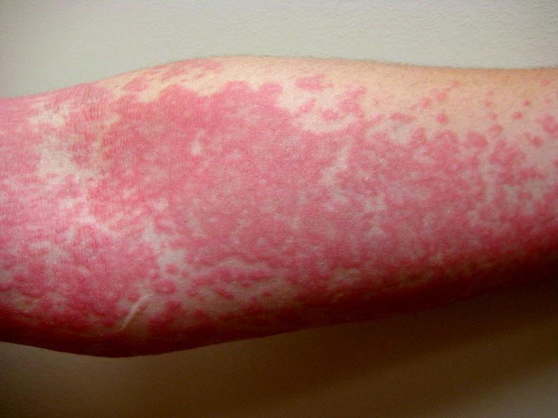 аллергия на коже что делать