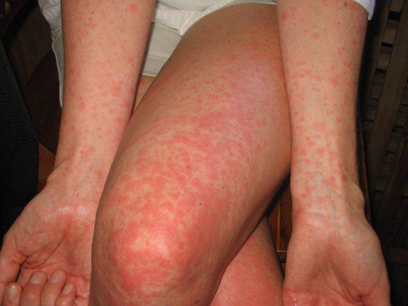 аллергия на коже крапивница