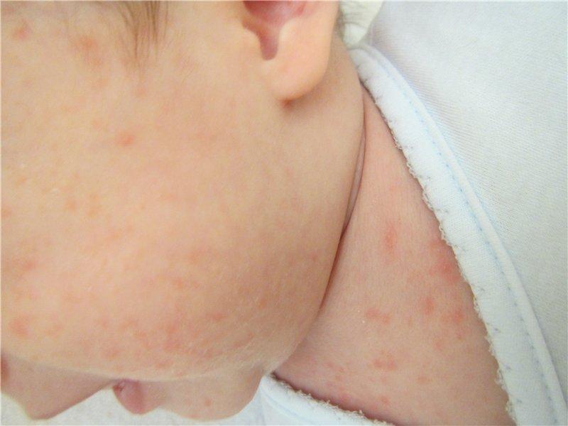 аллергия на стиральный порошок у ребенка