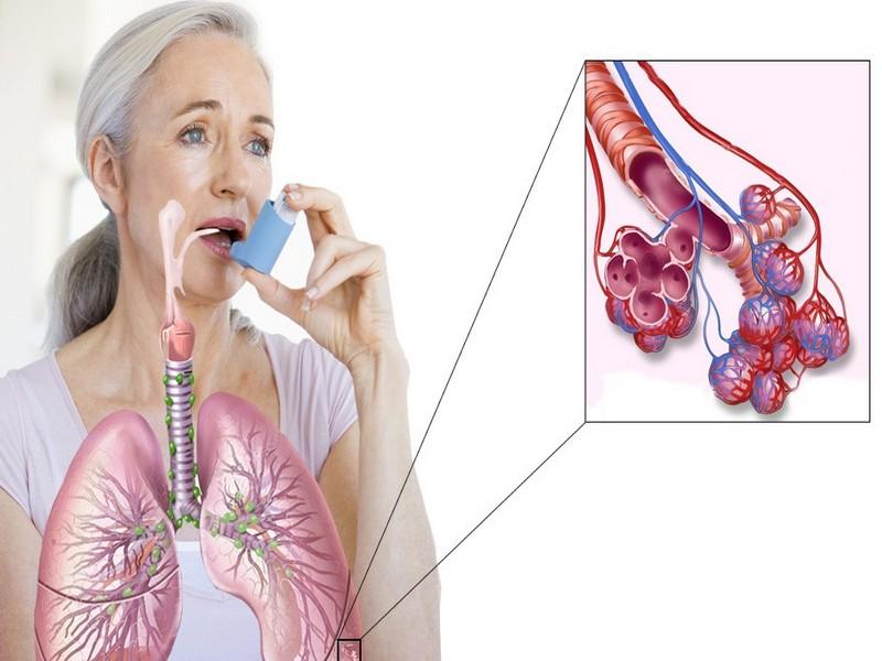 астма причины