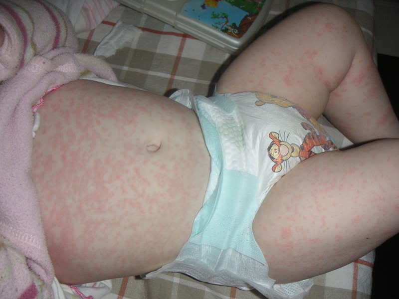 аллергия у ребенка лечение