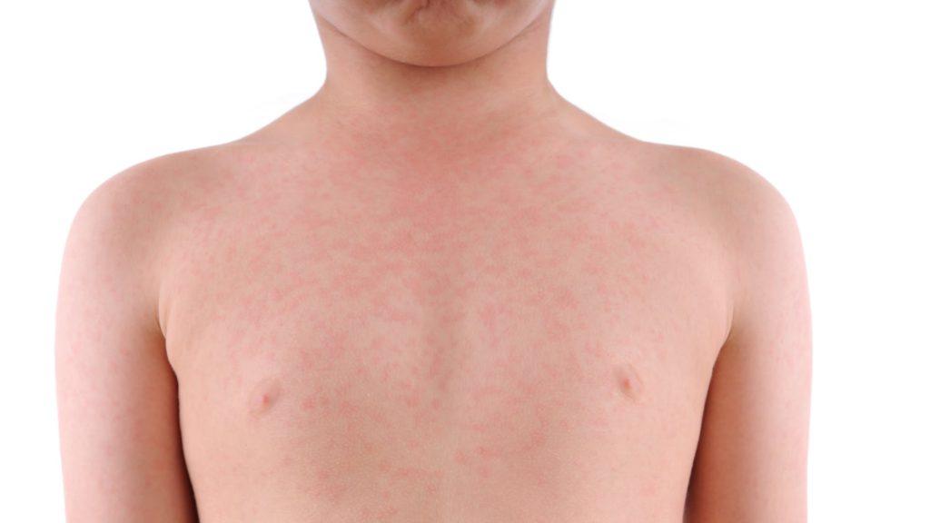 аллергия у ребенка сыпь