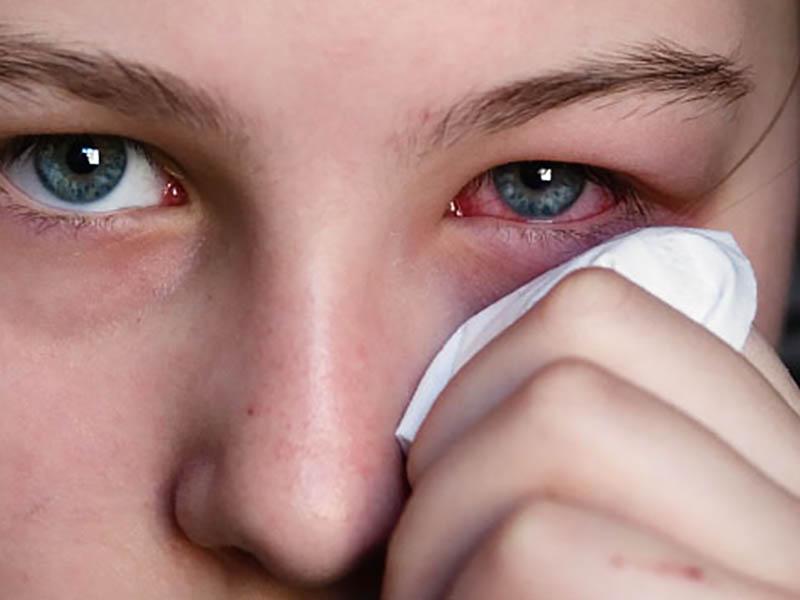 глазные капли от аллергии лечение
