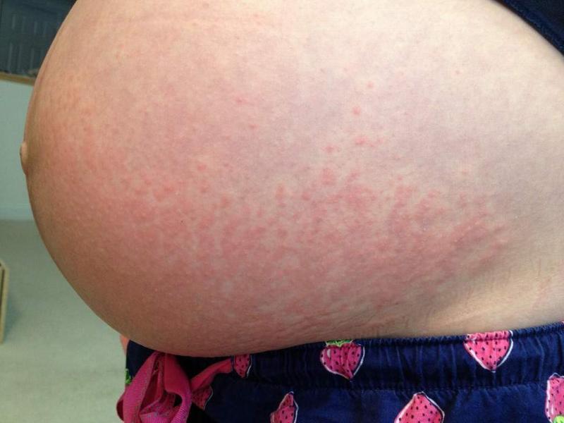 Крапивница при беременности | Аллергия