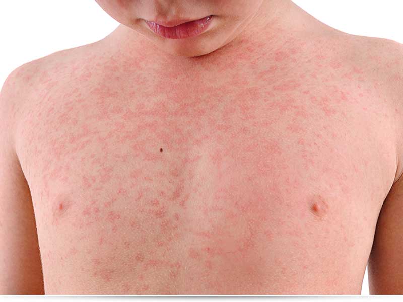 аллергическая сыпь у детей причины