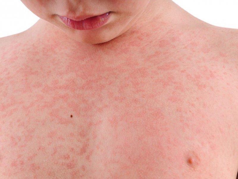 пищевая аллергия косвенные причины