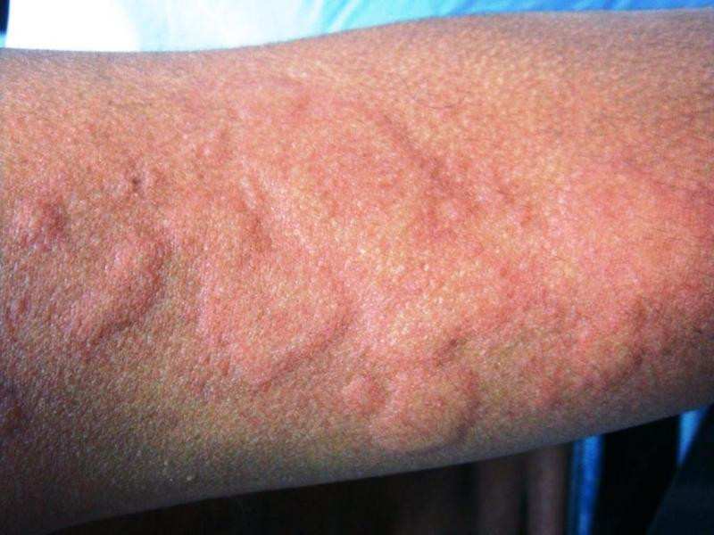 аллергия на семечки симптомы