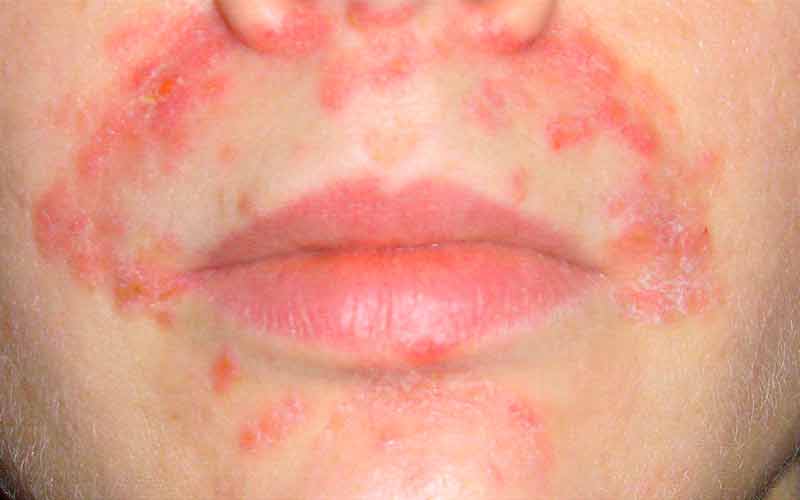 аллергия на антибиотики признаки