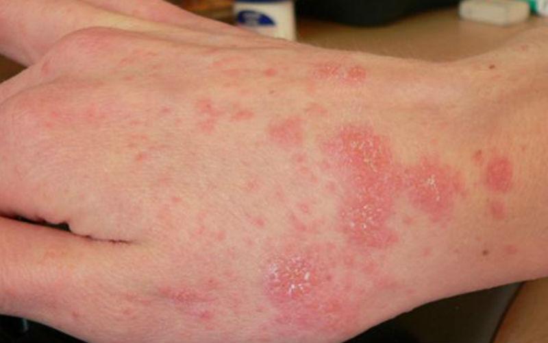 аллергия на антибиотики симптомы