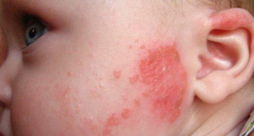 Красные точки на коже при аллергии