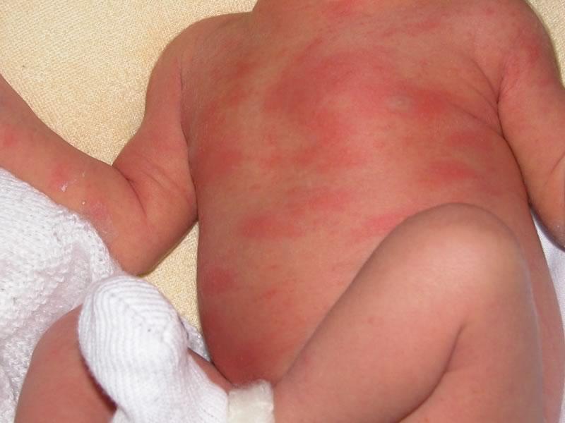 аллергические пятна на коже ребенка