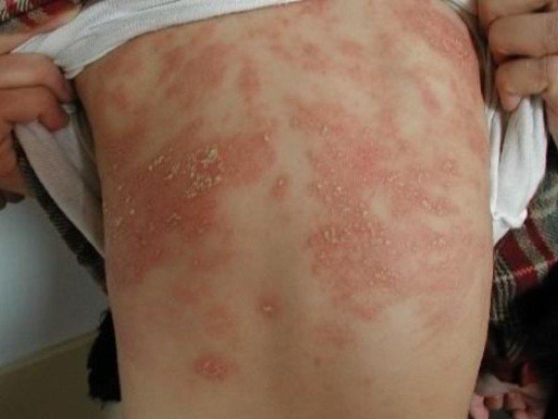аллергия на порошок у грудничка симптомы