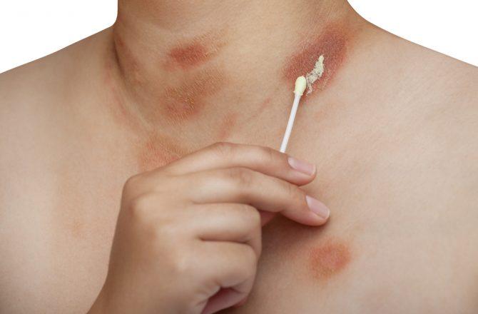 Лечение аллергии на коже народными средствами