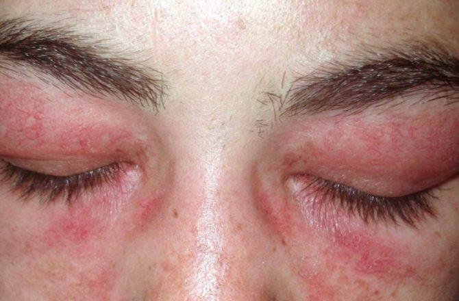 Лечение аллергии народными средствами