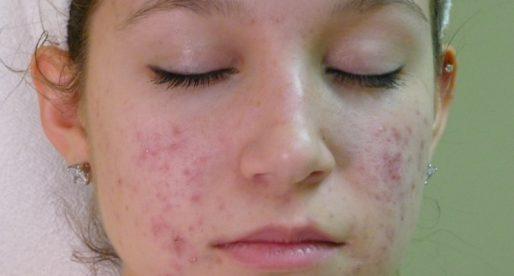 Аллергические высыпания на лице
