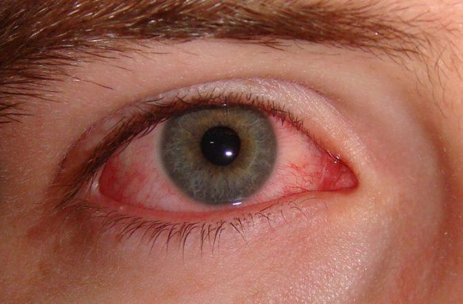Лечение аллергии на глазах народными средствами