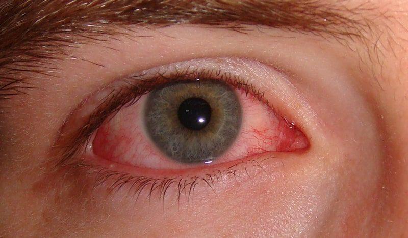Лечение аллергии на глазах народными средствами