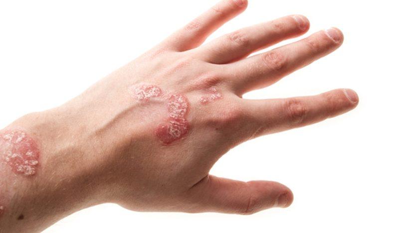 Аллергия на коже: фото, симптомы и проявления