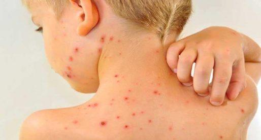 Аллергия в виде сыпи