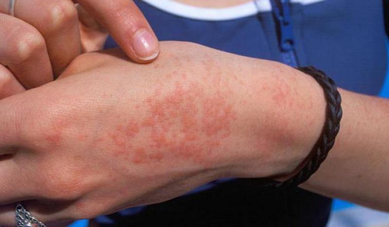 Аллергия на кистях рук