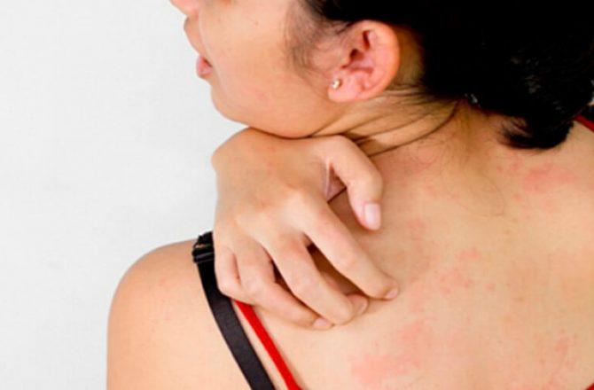 Что такое аллергический дерматит?