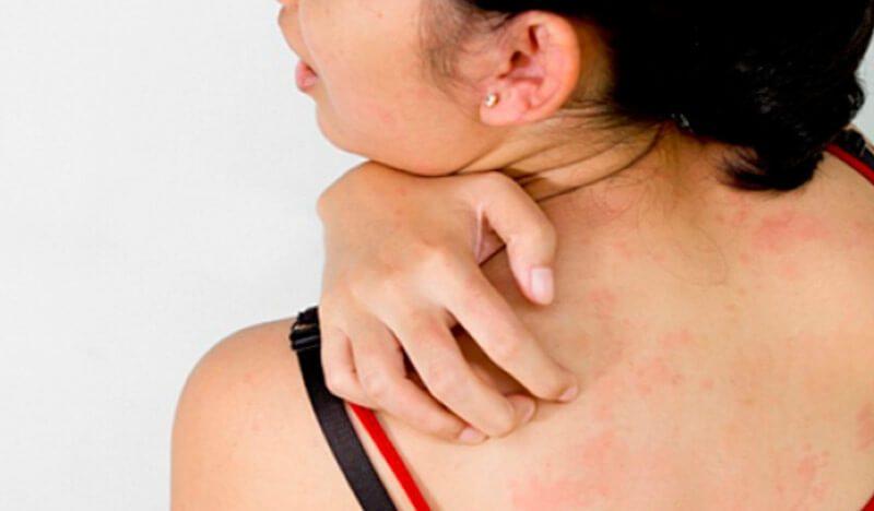 Что такое аллергический дерматит?