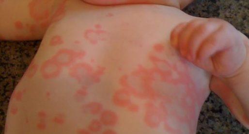 Различные проявления аллергии на коже
