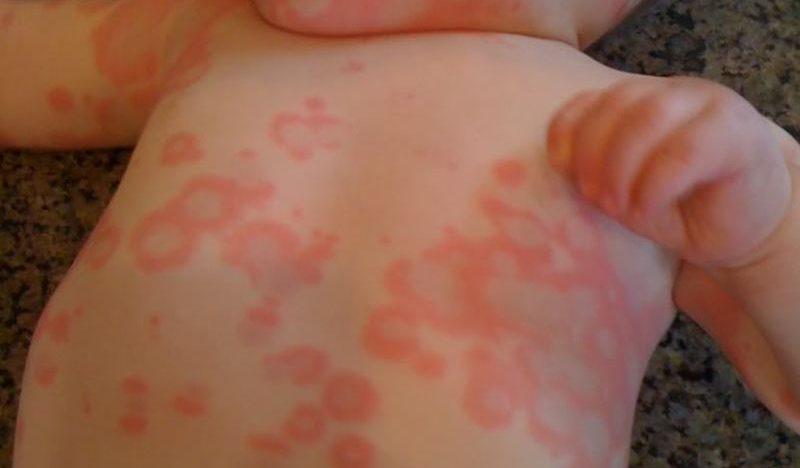 Различные проявления аллергии на коже