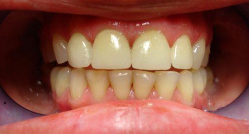 Аллергия на стоматологические протезы?