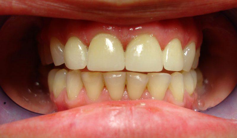 Аллергия на стоматологические протезы?