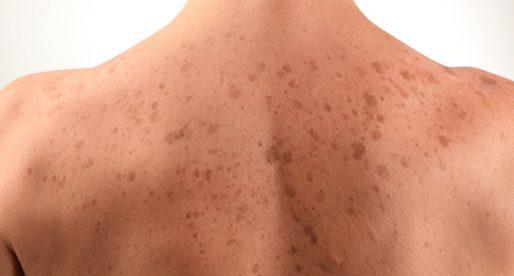 Как проявляется аллергия на коже спины?