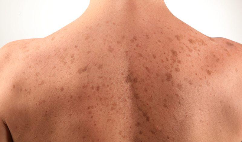 Как проявляется аллергия на коже спины?