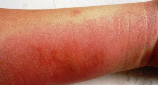 Проявление аллергии на руках