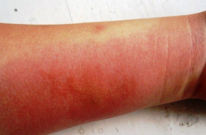 Проявление аллергии на руках