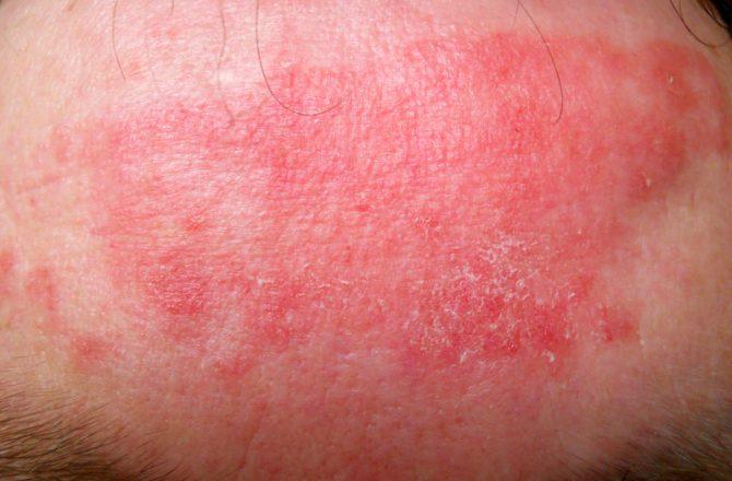 Токсический некролиз – особо опасная аллергия