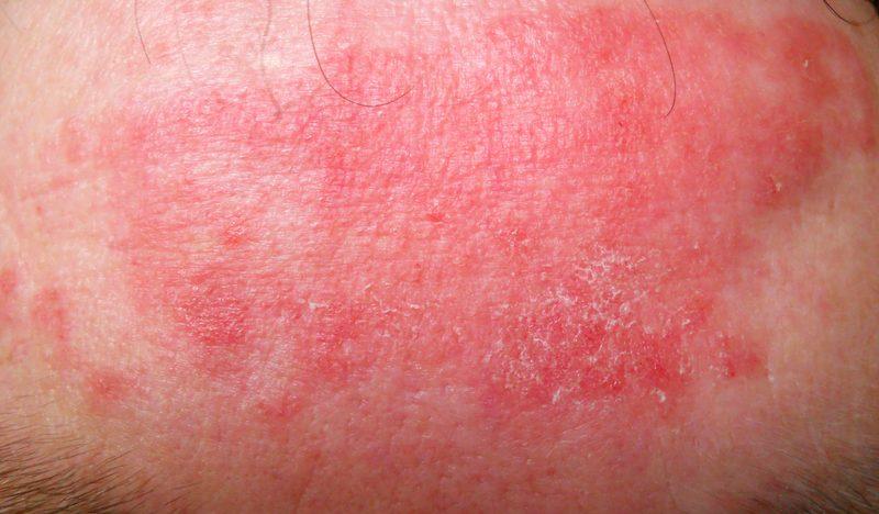 Токсический некролиз – особо опасная аллергия