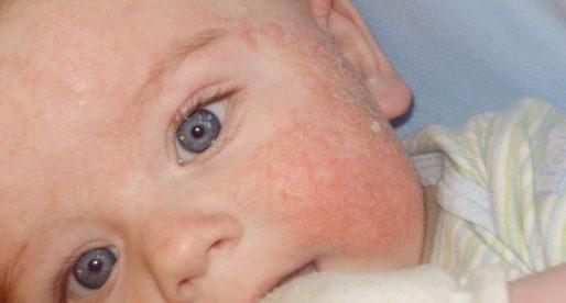 Аллергия на нурофен детский