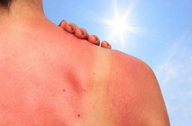 Аллергия на солнце: фото и лечение