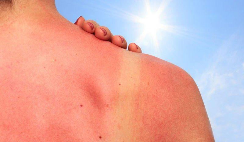 Аллергия на солнце: фото и лечение